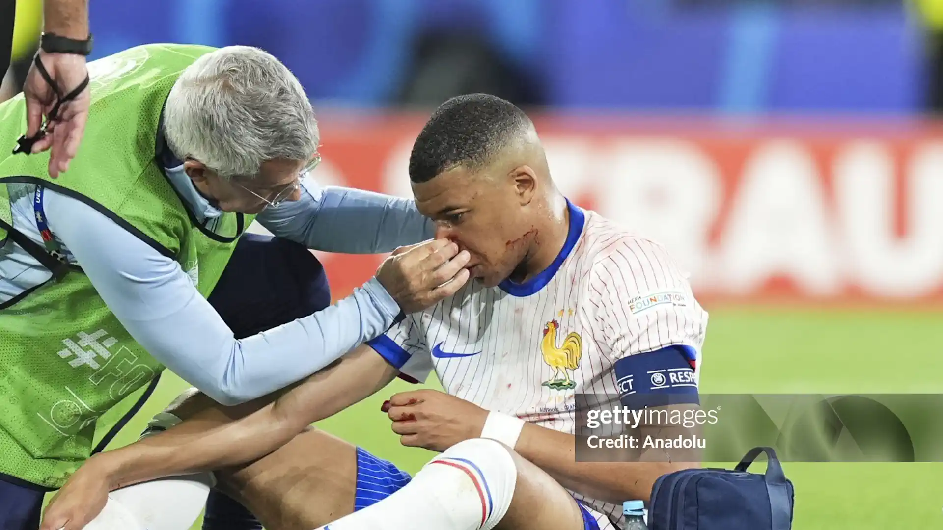 Kylian Mbappe's Injury at Euro 2024: Initial Results Are Encouraging